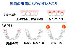 乳歯のむし歯になりやすい所