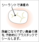 シーラント