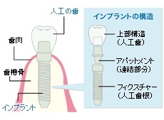 インプラントのしくみ