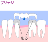 ブリッジ