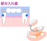 部分入れ歯