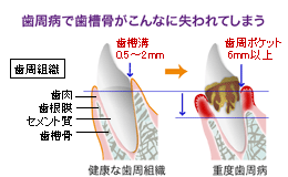 歯周病で歯槽骨がこんなにも失われてしまう