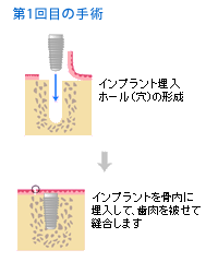 インプラントの1次手術