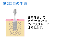 2回目の手術