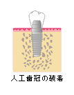 人工歯の取り付け